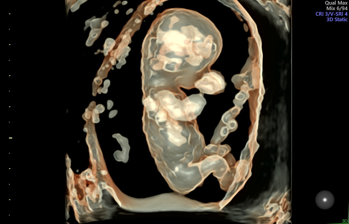 Tamizaje 1er trimestre